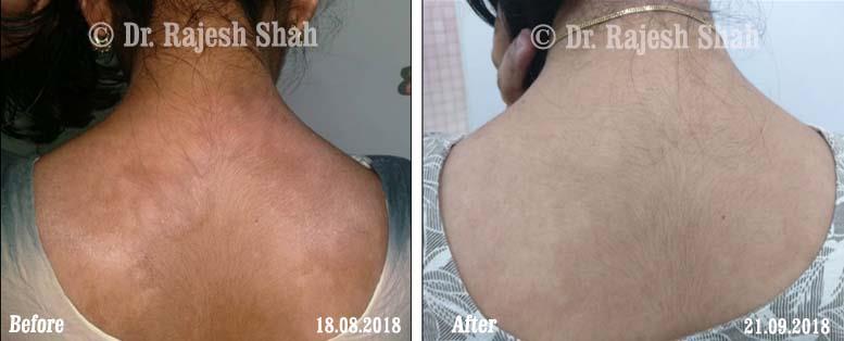 Psoriasis Before and After Case Photo