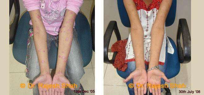 Psoriasis Before and After Case Photo