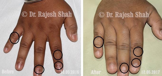 Vitiligo Before and After Case Photo