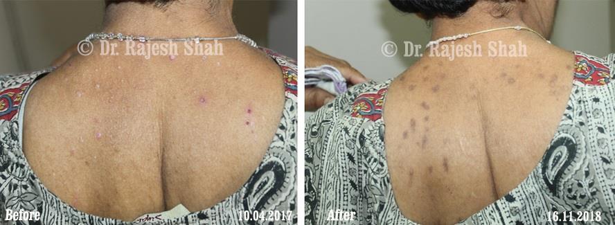Lichen Planus Before and After Case Photo