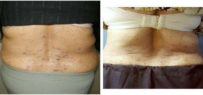 Lichen Planus Before and After Case Photo