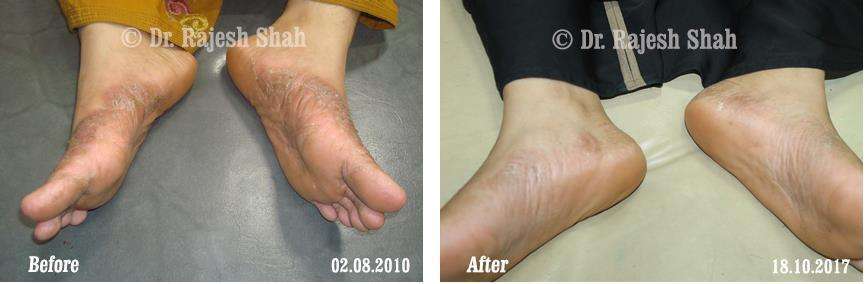 Psoriasis Before and After Case Photo