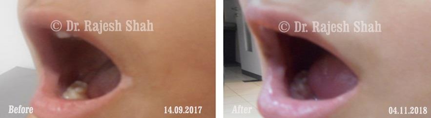 Vitiligo Before and After Case Photo