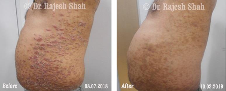 Psoriasis Before and After Case Photo