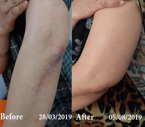 Psoriasis Before and After Case Photo