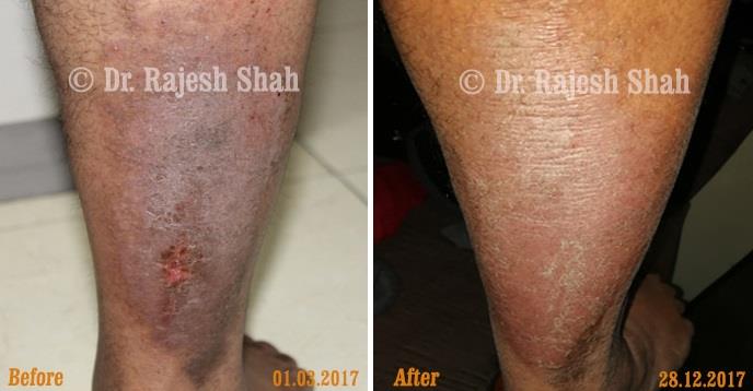 Eczema Before and After Case Photo