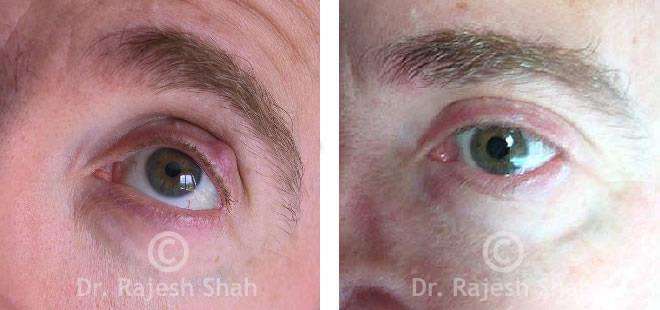 Chalazion Before and After Case Photo