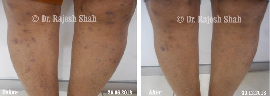 Lichen Planus Before and After Case Photo