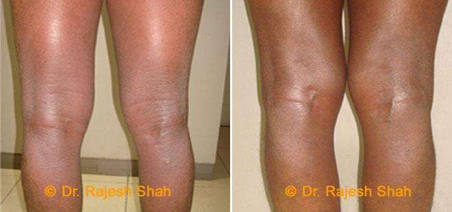 Eczema Before and After Case Photo