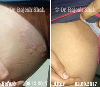 Tinea Before and After Case Photo