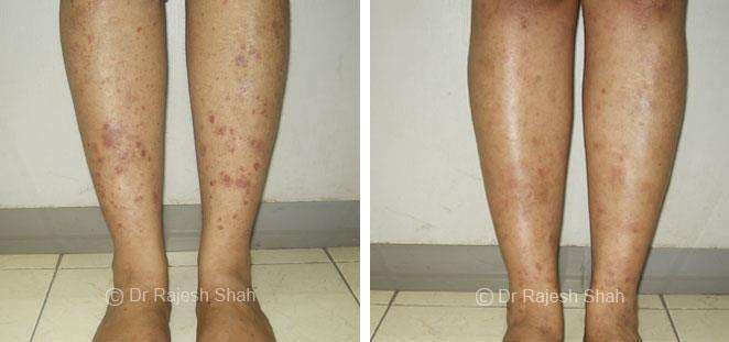 Psoriasis Before and After Case Photo