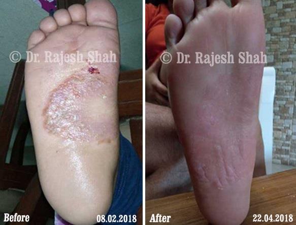 Eczema Before and After Case Photo