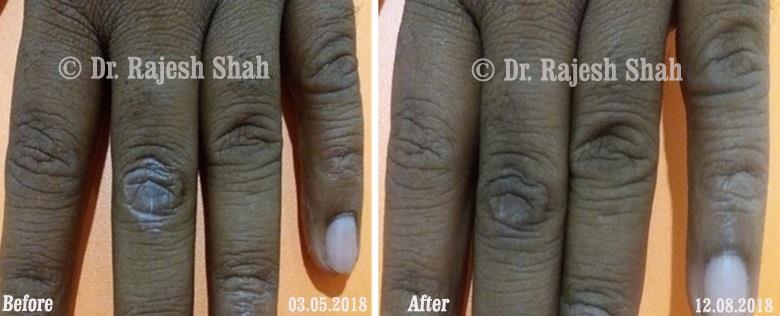 Psoriasis Before and After Case Photo