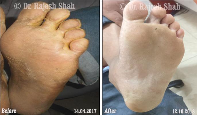 Psoriasis Before and After Case Photo