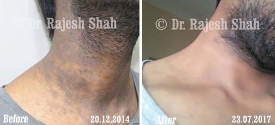 Lichen Planus Pigmentosa