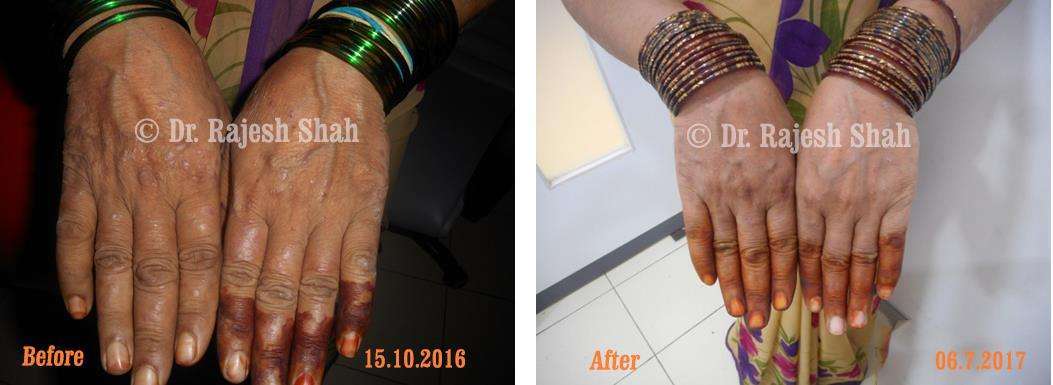 Psoriasis Before and After Case Photo