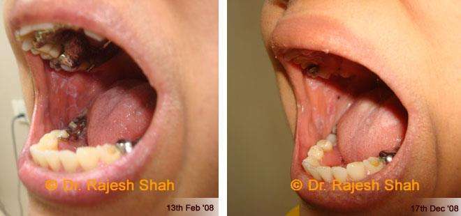 Lichen Planus Before and After Case Photo