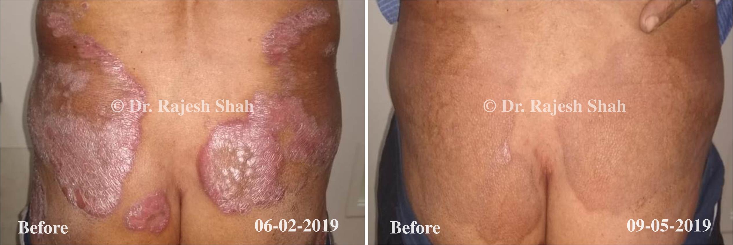 Psoriasis Before and After Case Photo