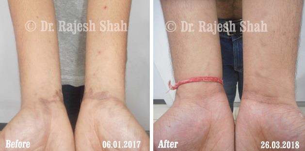 Lichen Planus Before and After Case Photo