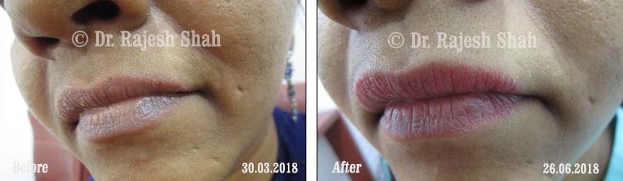 Cheilitis Before and After Case Photo