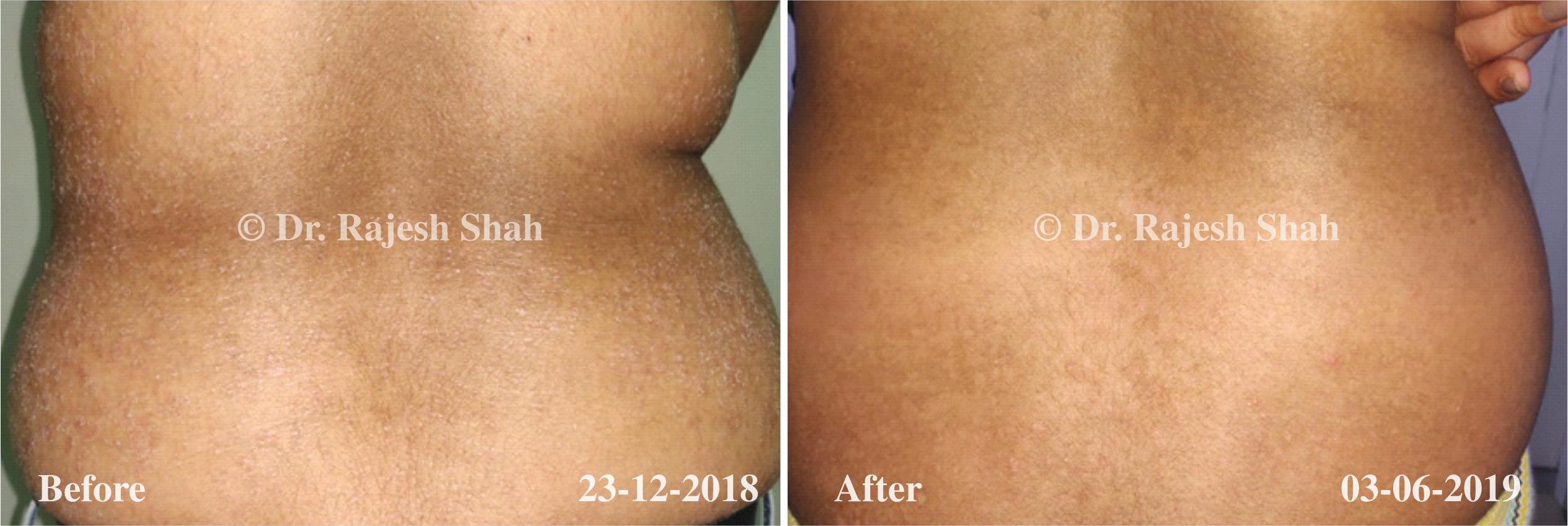 Psoriasis Before and After Case Photo