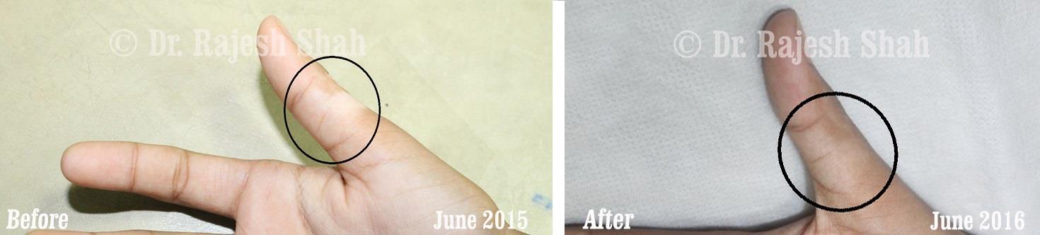 Vertigo Before and After Case Photo