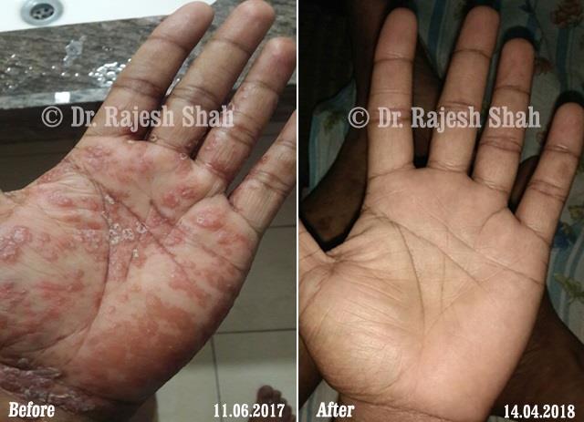 Psoriasis Before and After Case Photo