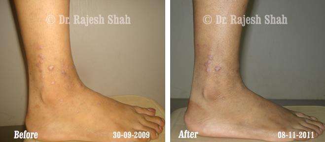 Lichen Planus Before and After Case Photo