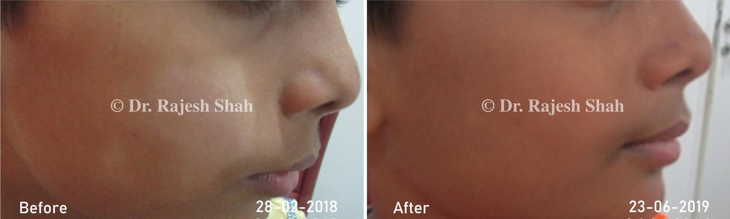 Pityriasis Alba Before and After Case Photo