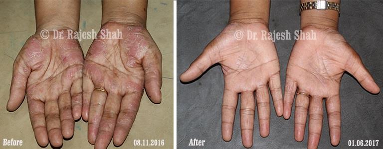 Psoriasis Before and After Case Photo