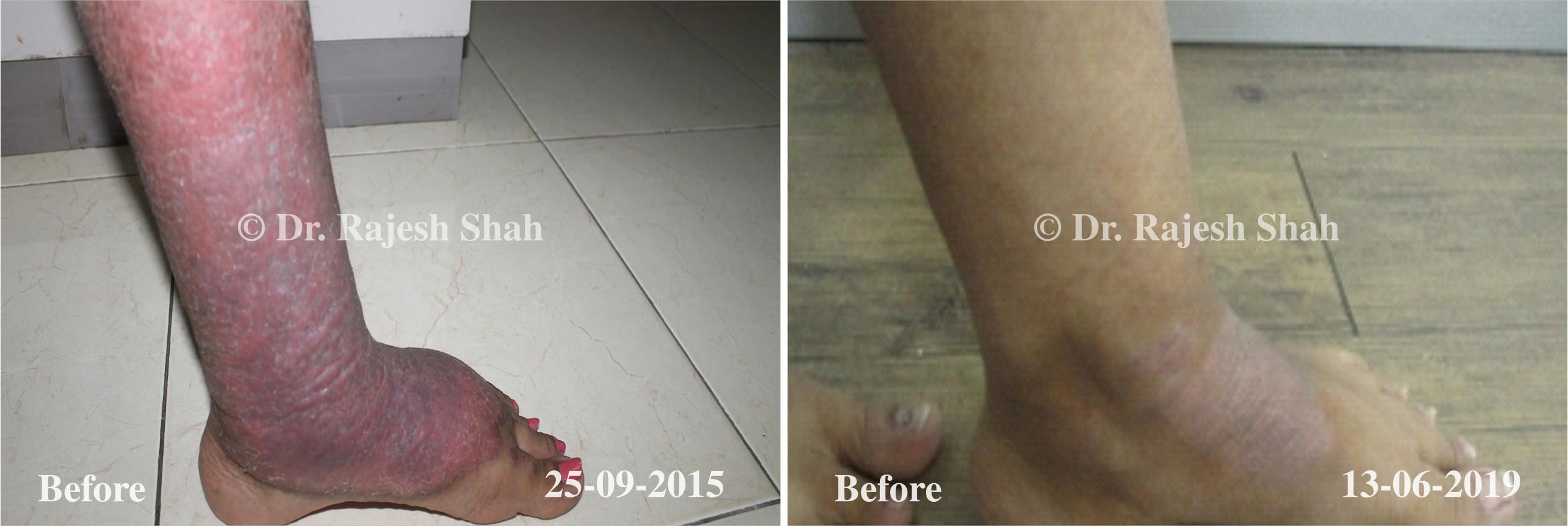 Psoriasis Before and After Case Photo