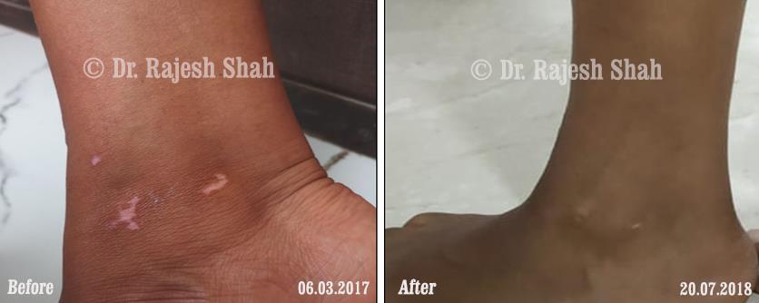 Vitiligo Before and After Case Photo