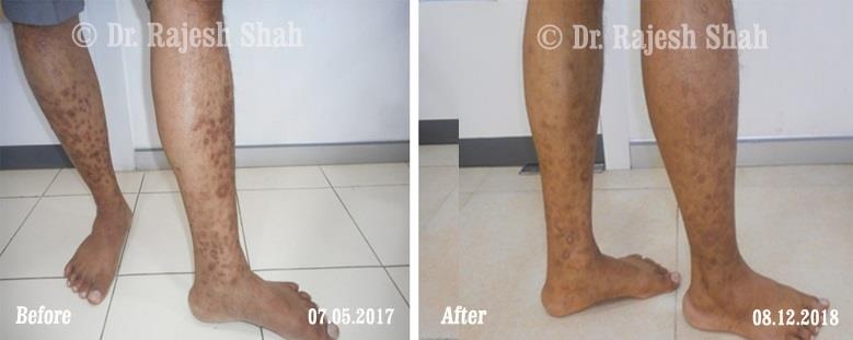 Lichen Planus Before and After Case Photo