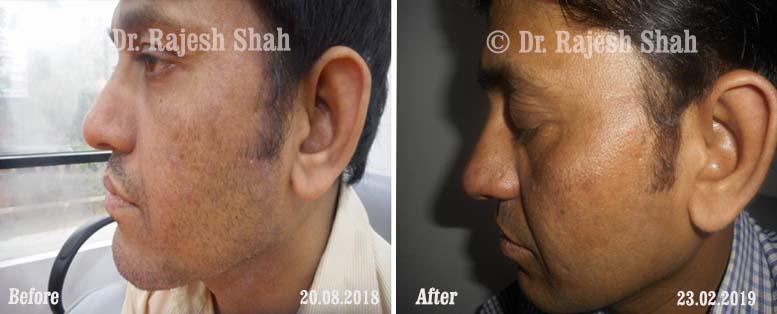 Eczema Before and After Case Photo