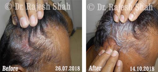 Psoriasis Before and After Case Photo