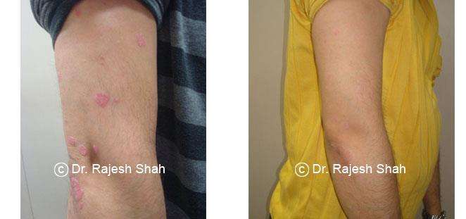 Psoriasis Before and After Case Photo