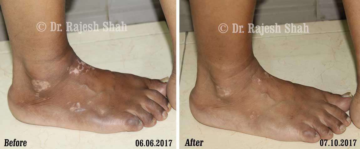 Vitiligo Before and After Case Photo