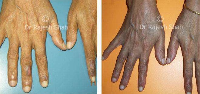 Vitiligo Before and After Case Photo
