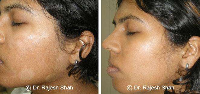 Psoriasis Before and After Case Photo