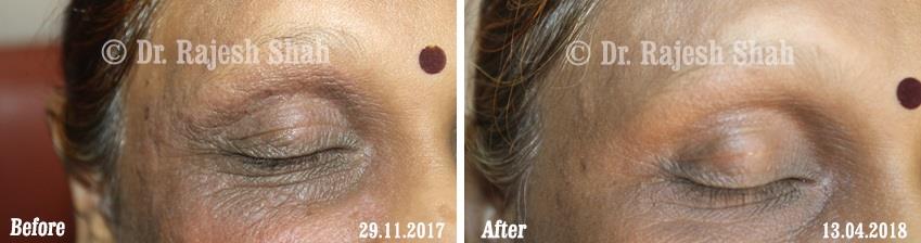 Eczema Before and After Case Photo