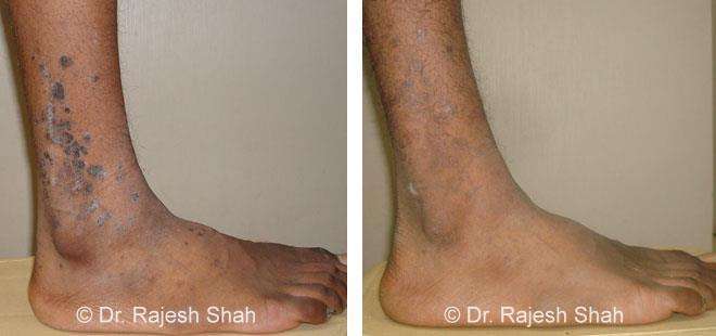 Lichen Planus Before and After Case Photo