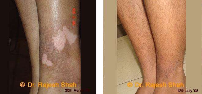 Vitiligo Before and After Case Photo