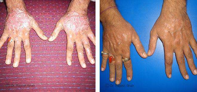 Psoriasis Before and After Case Photo