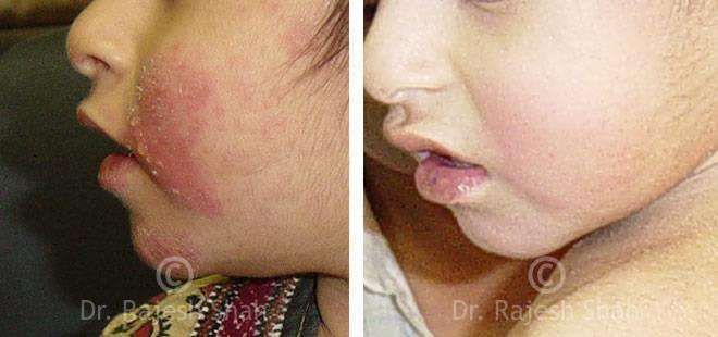 Eczema Before and After Case Photo