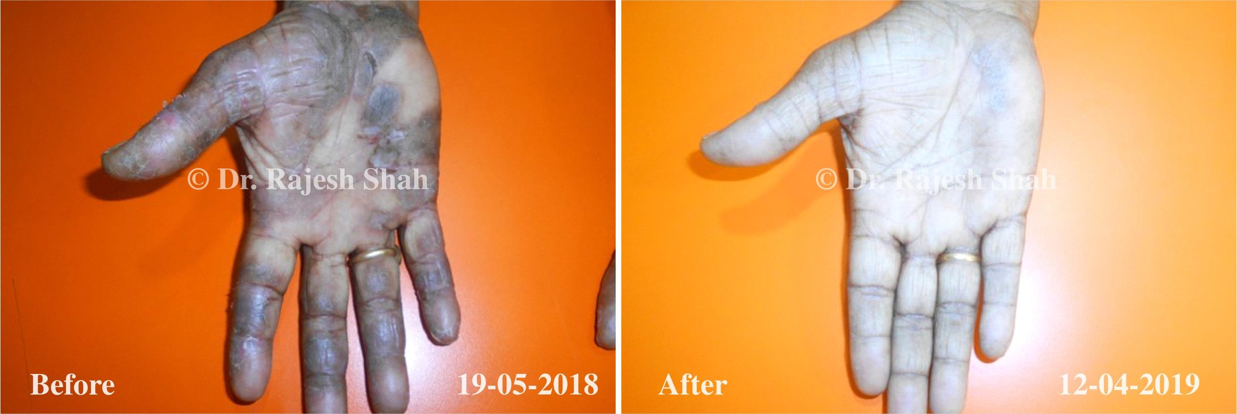 Psoriasis Before and After Case Photo