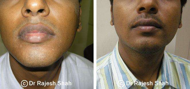 Vitiligo Before and After Case Photo