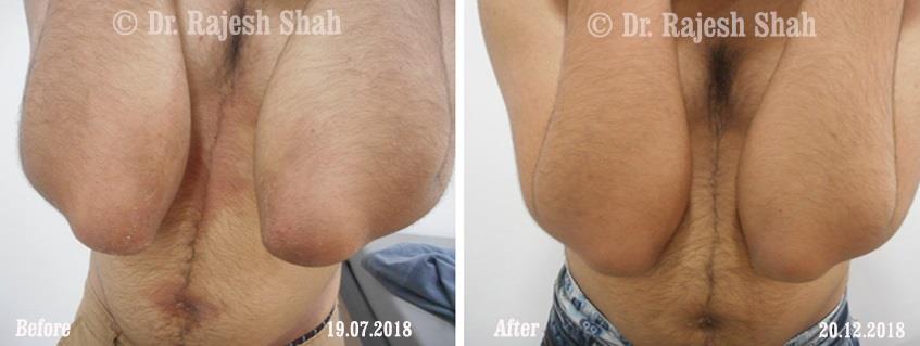 Atopic Dermatitis Before and After Case Photo