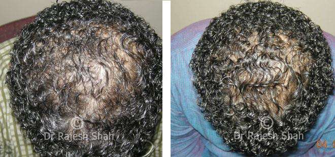 Hair loss Before and After Case Photo