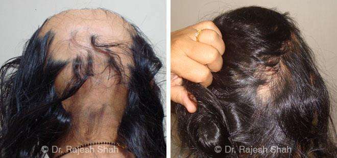 Alopecia Areata Before and After Case Photo