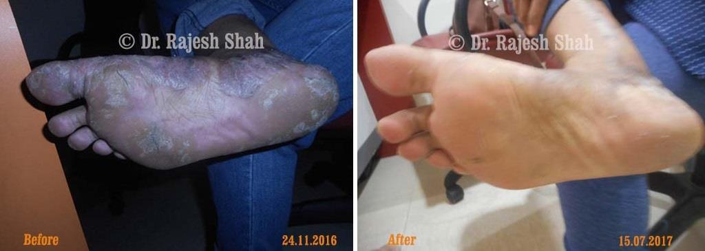 Psoriasis Before and After Case Photo